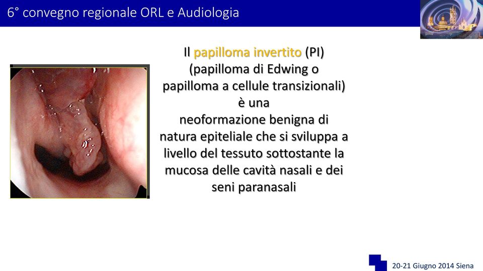 benigna di natura epiteliale che si sviluppa a livello del