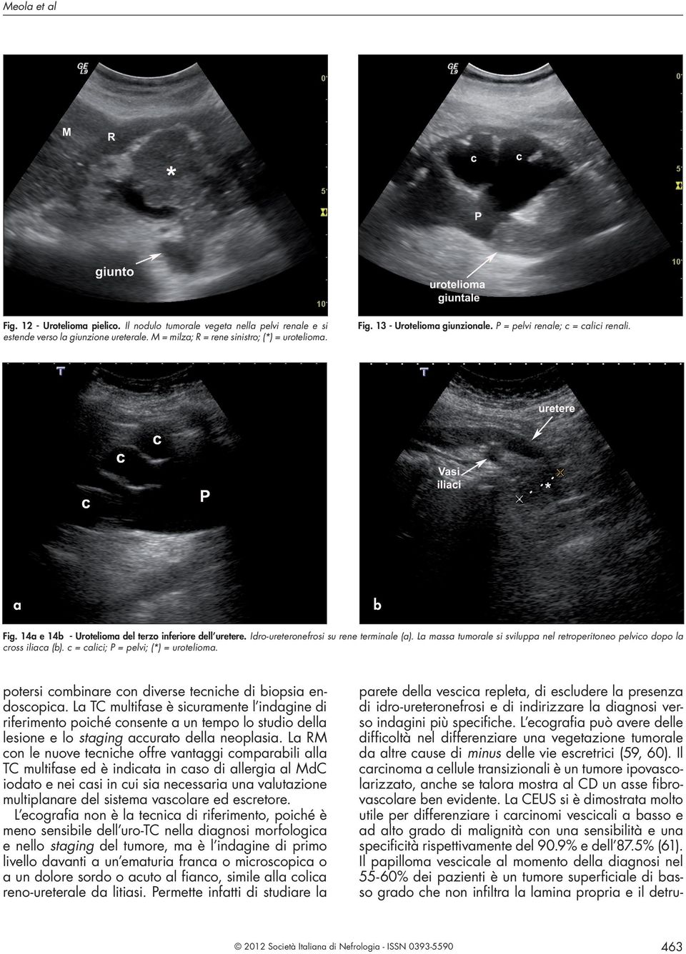 L mss tumorle si svilupp nel retroperitoneo pelvico dopo l cross ilic (). c = clici; P = pelvi; (*) = uroteliom. potersi cominre con diverse tecniche di iopsi endoscopic.