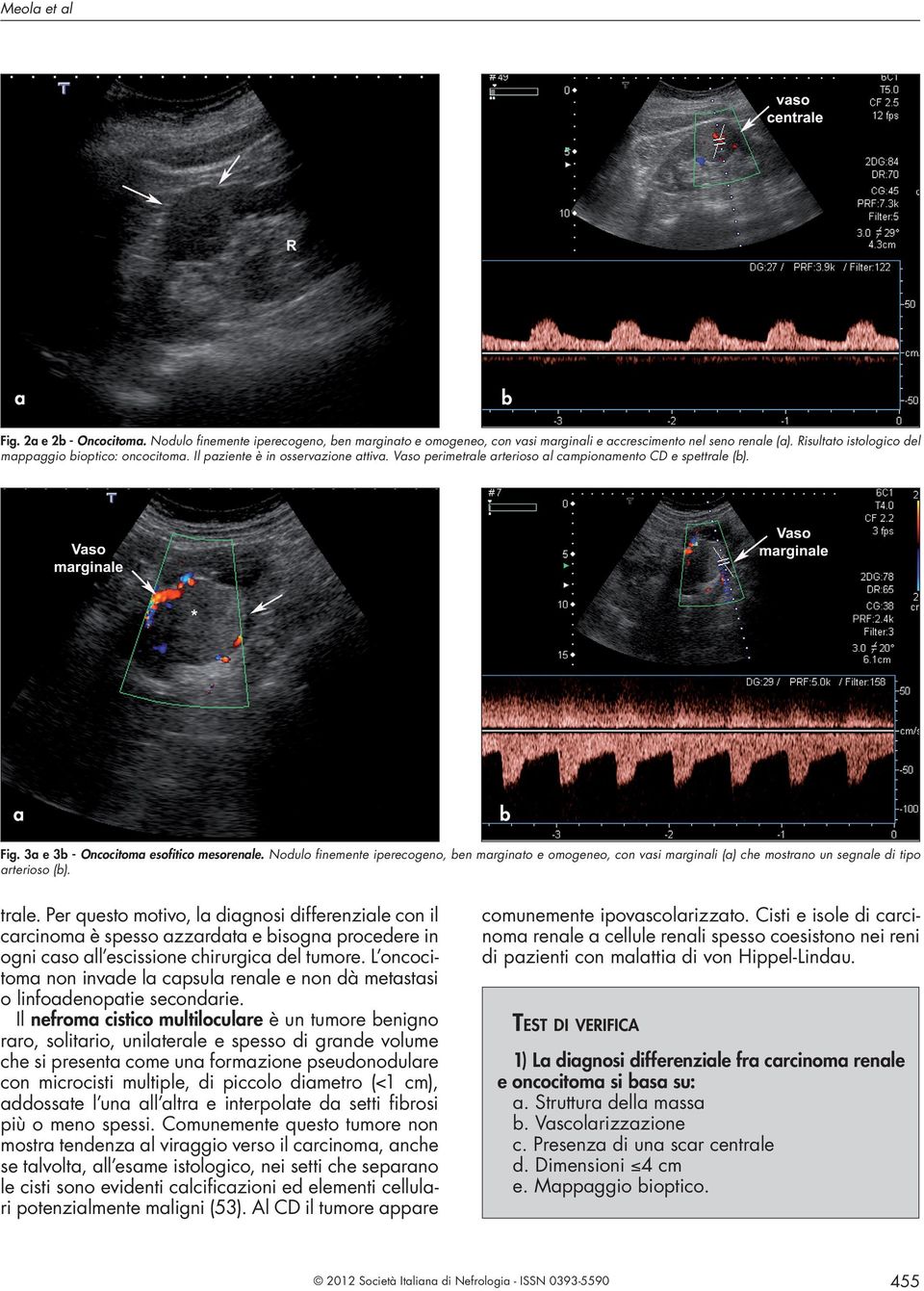 Nodulo finemente iperecogeno, en mrginto e omogeneo, con vsi mrginli () che mostrno un segnle di tipo rterioso (). trle.