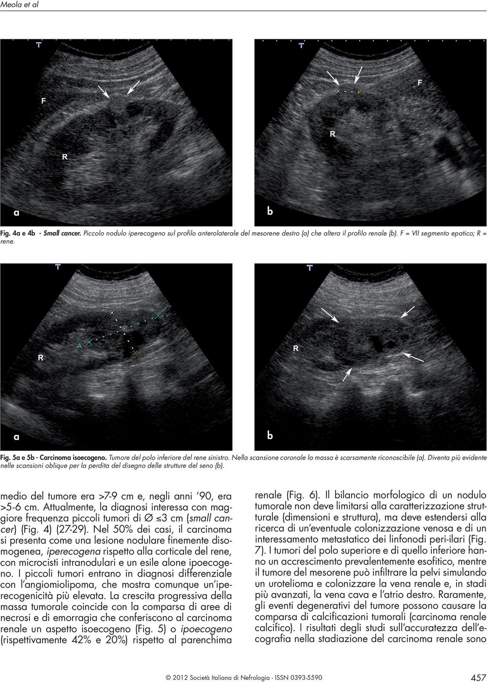 medio del tumore er >7-9 cm e, negli nni 90, er >5-6 cm. Attulmente, l dignosi interess con mggiore frequenz piccoli tumori di Ø 3 cm (smll cncer) (Fig. 4) (27-29).