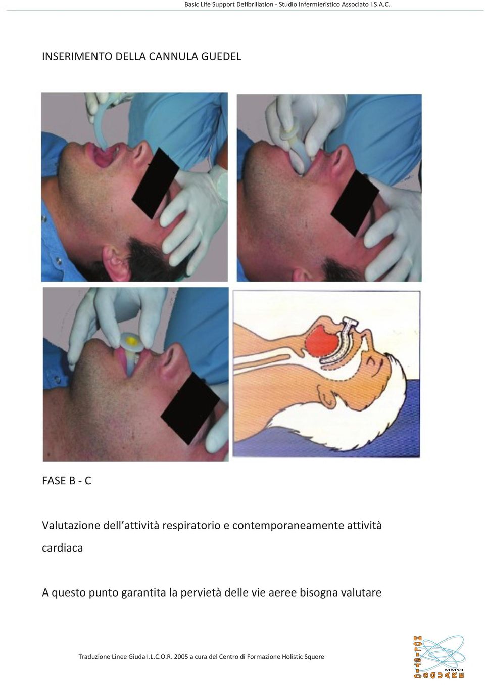 INSERIMENTO DELLA CANNULA GUEDEL FASE B - C Valutazione dell