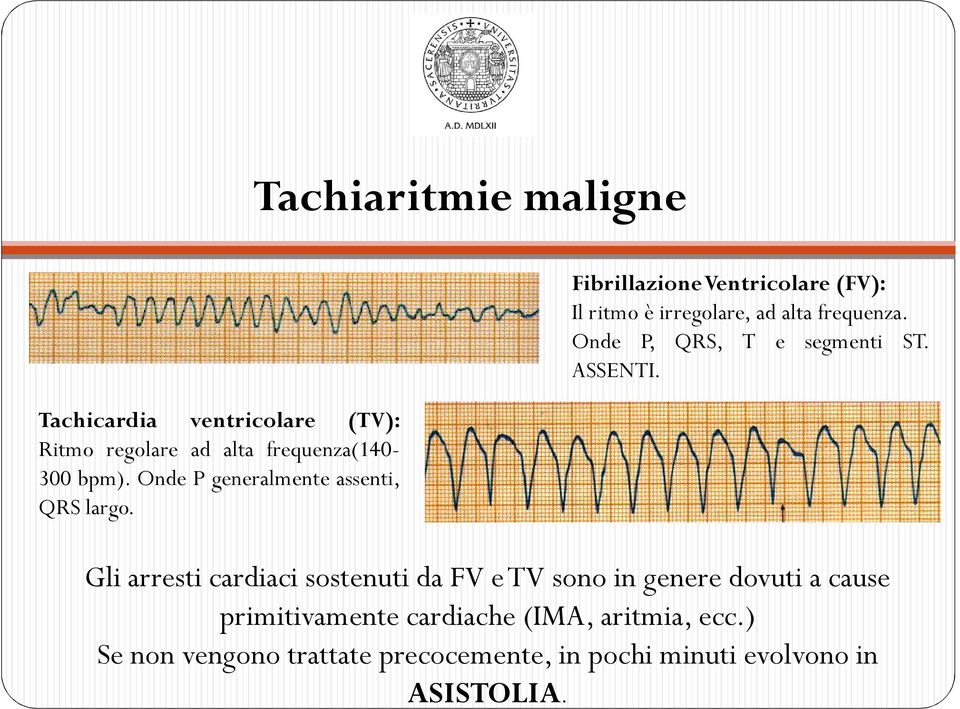 FibrillazioneVentricolare (FV): Il ritmo è irregolare, ad alta frequenza. Onde P, QRS, T e segmenti ST. ASSENTI.