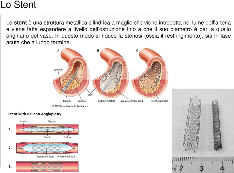 ostruzione fino a che il suo diametro è pari a quello originario del vaso.