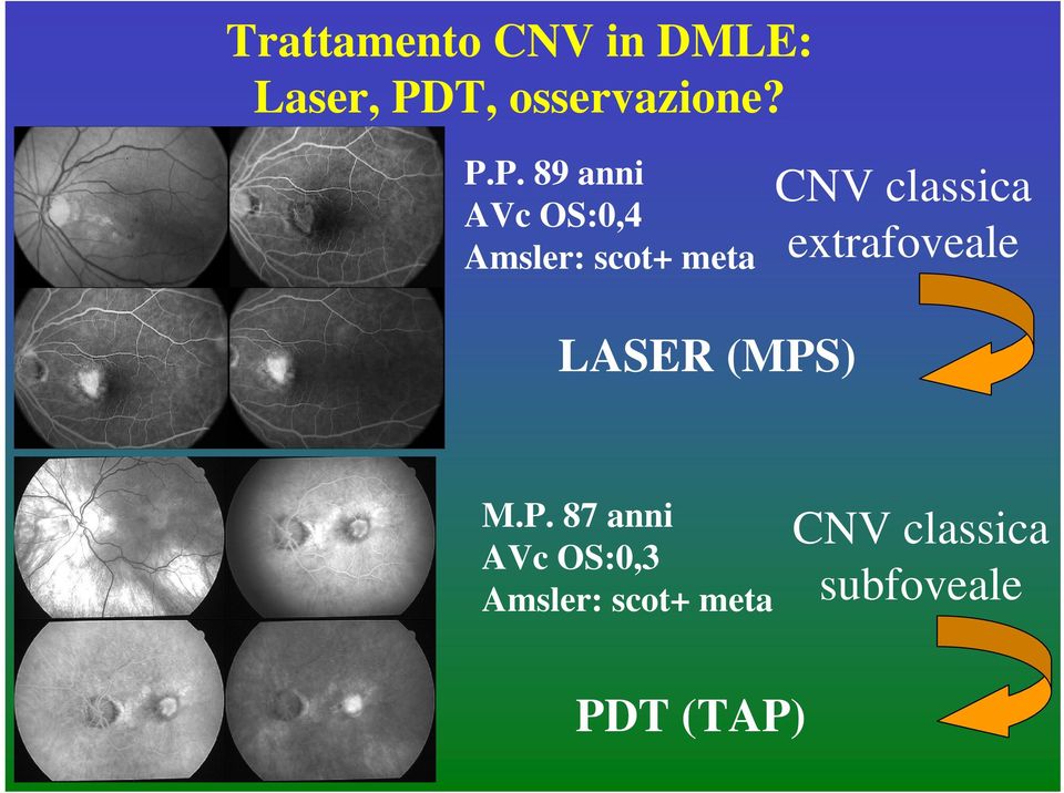 (MPS) CNV classica extrafoveale M.P. 87 anni AVc