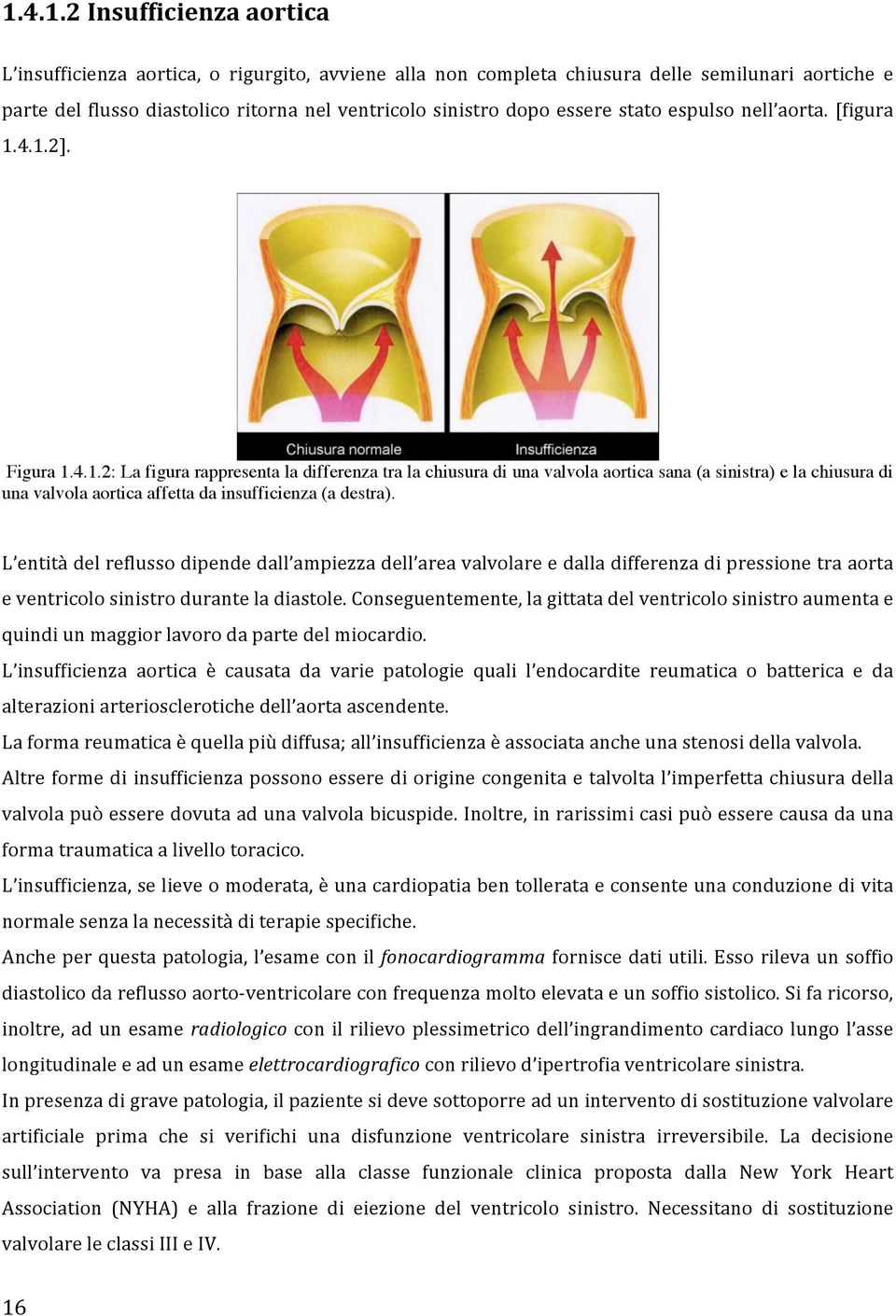 4.1.2]. Figura 1.4.1.2: La figura rappresenta la differenza tra la chiusura di una valvola aortica sana (a sinistra) e la chiusura di una valvola aortica affetta da insufficienza (a destra).