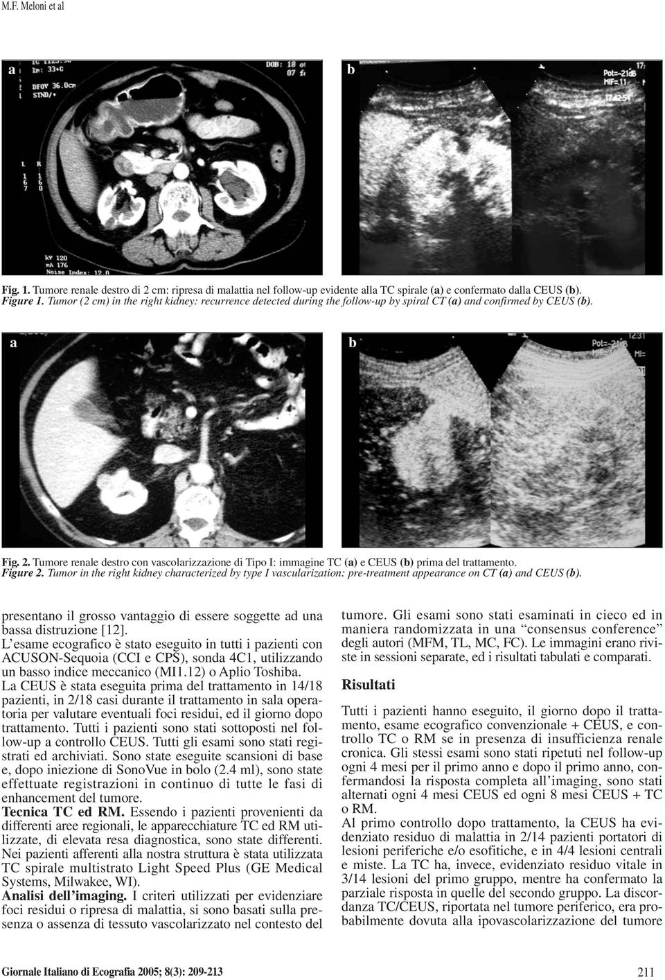 Tumore renle destro con vscolrizzzione di Tipo I: immgine TC () e CEUS () prim del trttmento. Figure 2.