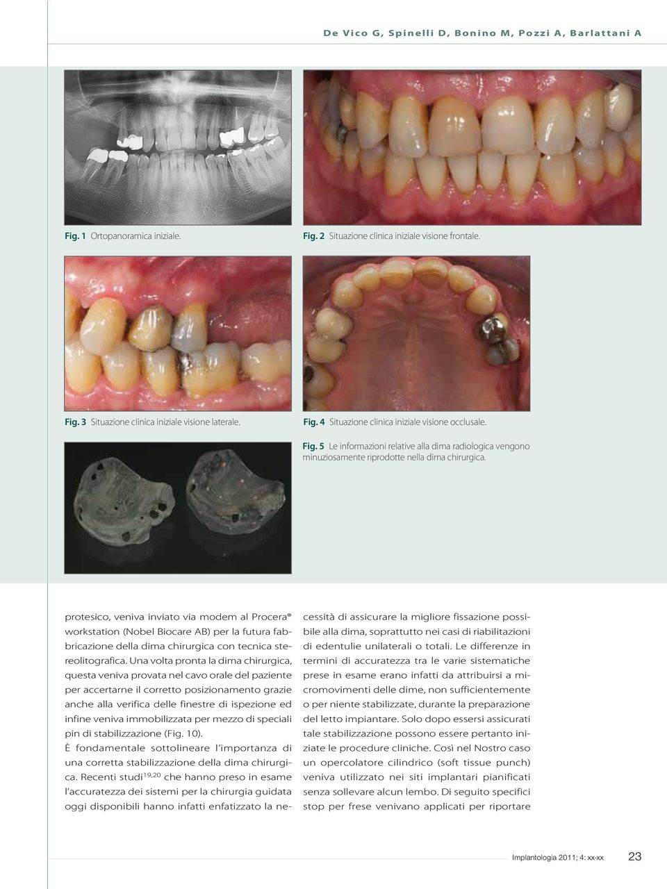 Una volta pronta la dima chirurgica, questa veniva provata nel cavo orale del paziente per accertarne il corretto posizionamento grazie anche alla verifica delle finestre di ispezione ed infine