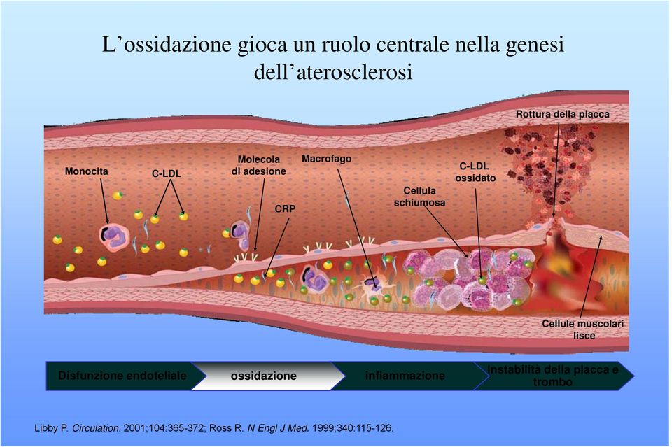 muscolari lisce Disfunzione endoteliale ossidazione infiammazione Instabilità della placca