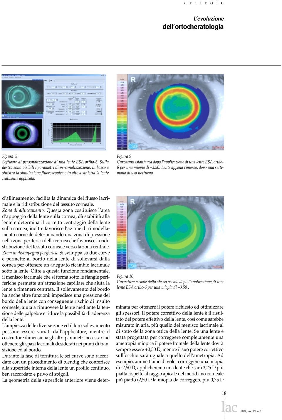 Figura 9 Curvatura istantanea dopo l applicazione di una lente ESA ortho- 6 per una miopia di 3.50. Lente appena rimossa, dopo una settimana di uso notturno.