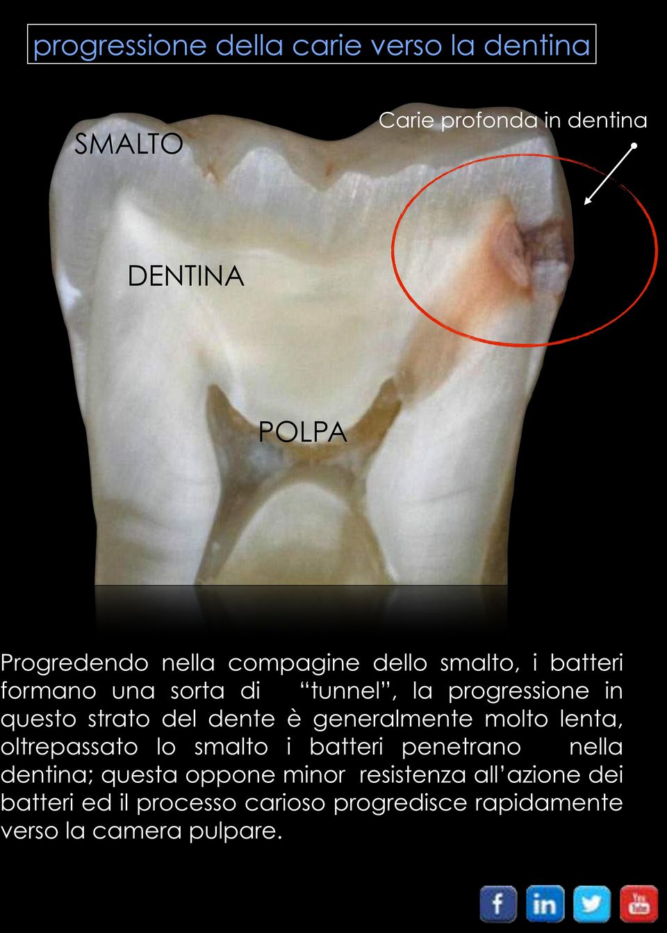 dente è generalmente molto lenta, oltrepassato lo smalto i batteri penetrano nella dentina; questa oppone