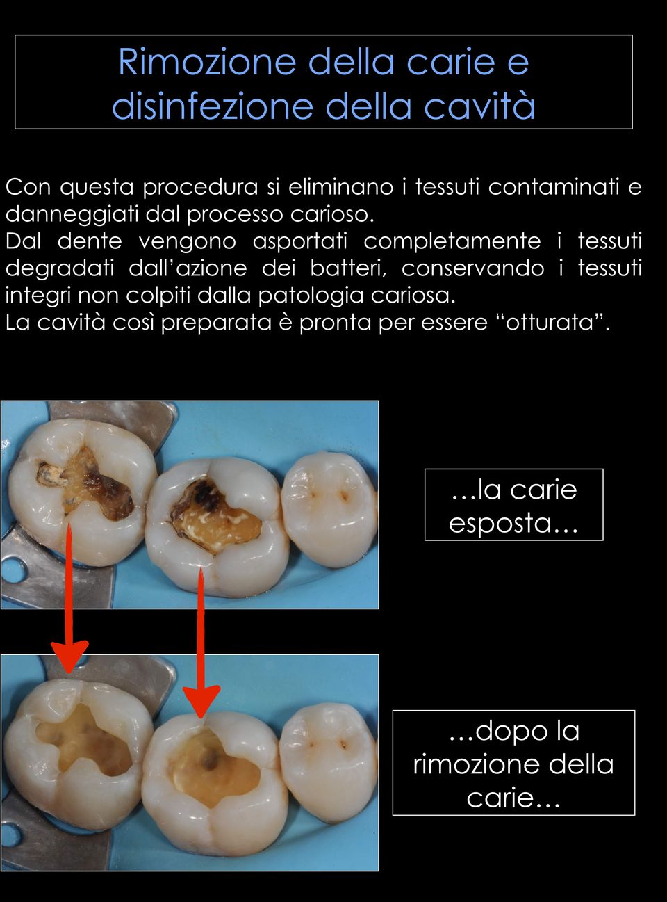 Dal dente vengono asportati completamente i tessuti degradati dall azione dei batteri, conservando