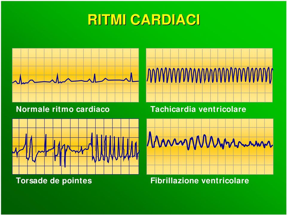 ventricolare Torsade de