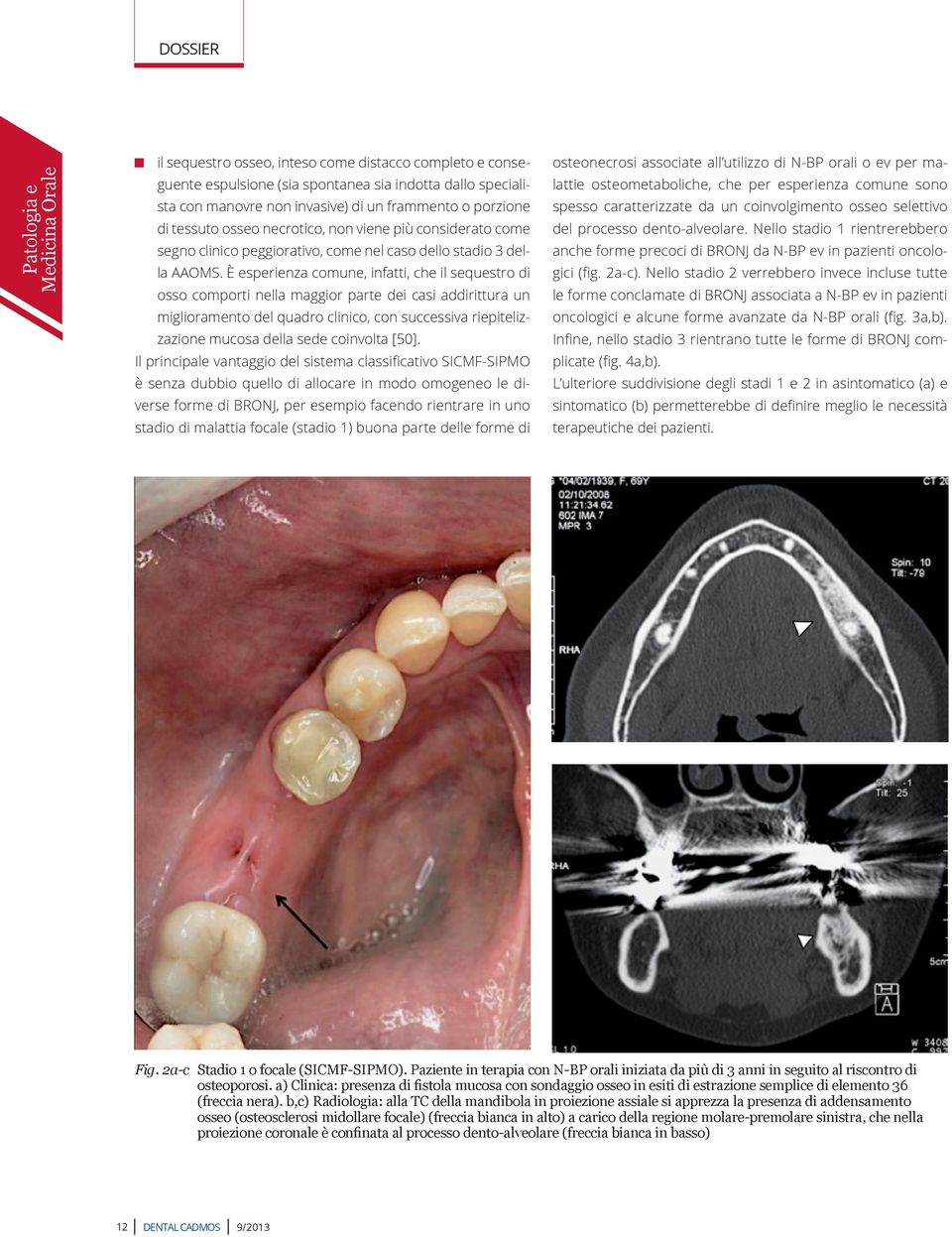 È esperienza comune, infatti, che il sequestro di osso comporti nella maggior parte dei casi addirittura un miglioramento del quadro clinico, con successiva riepitelizzazione mucosa della sede