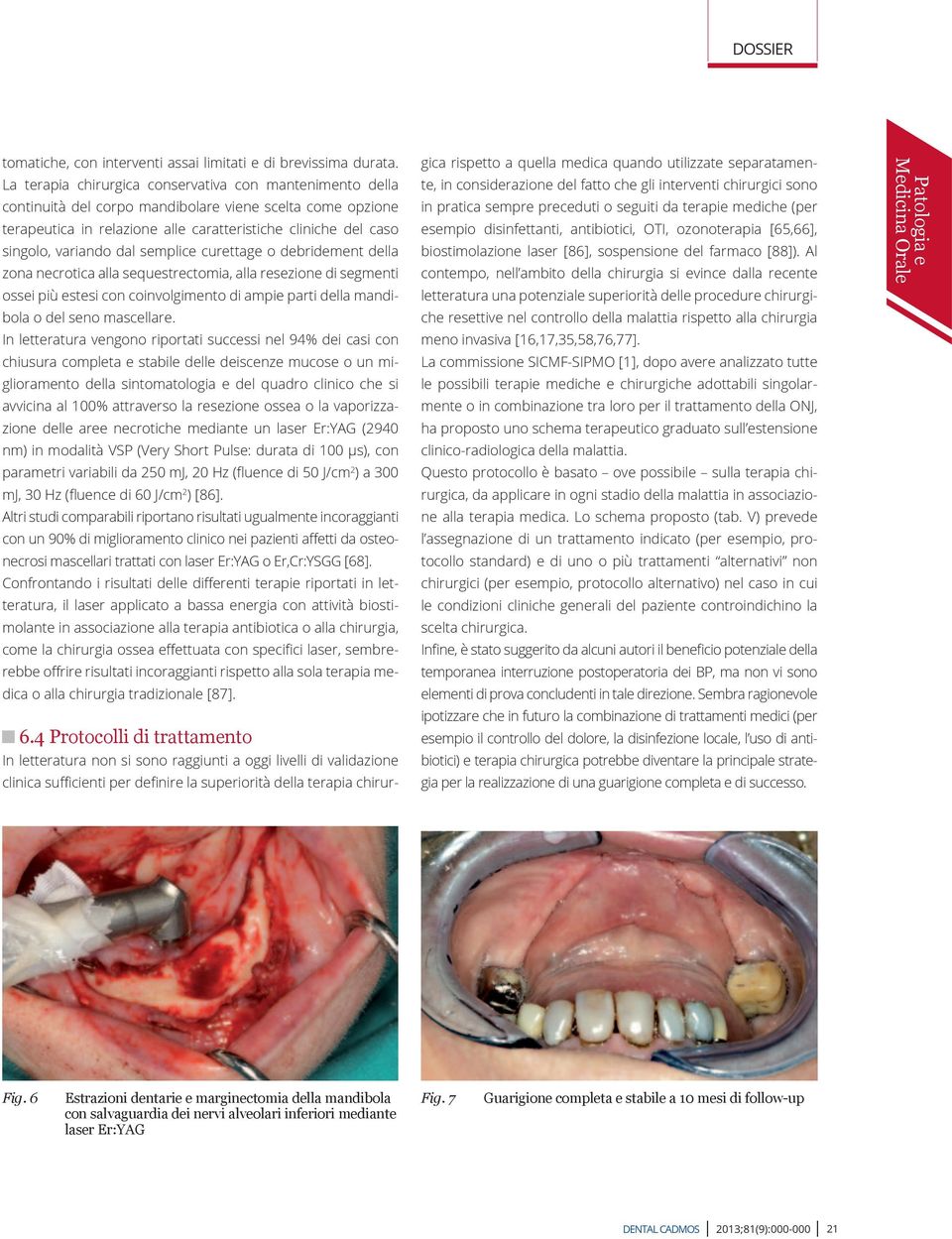 dal semplice curettage o debridement della zona necrotica alla sequestrectomia, alla resezione di segmenti ossei più estesi con coinvolgimento di ampie parti della mandibola o del seno mascellare.