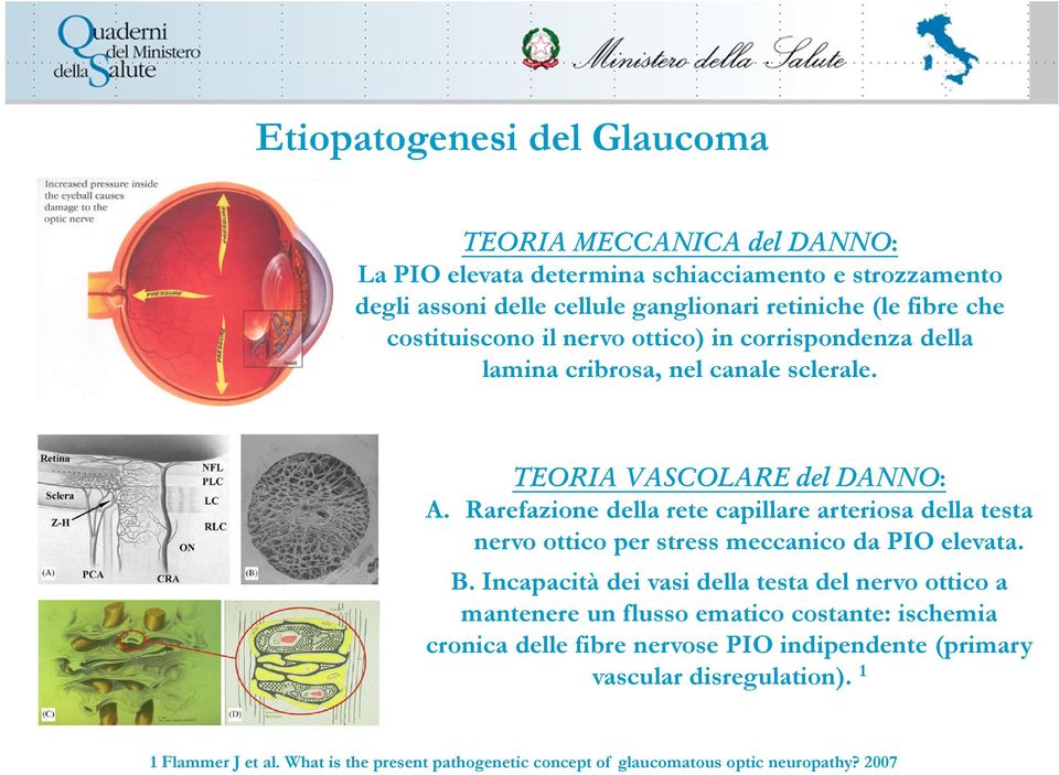 Rarefazione della rete capillare arteriosa della testa nervo ottico per stress meccanico da PIO elevata. B.