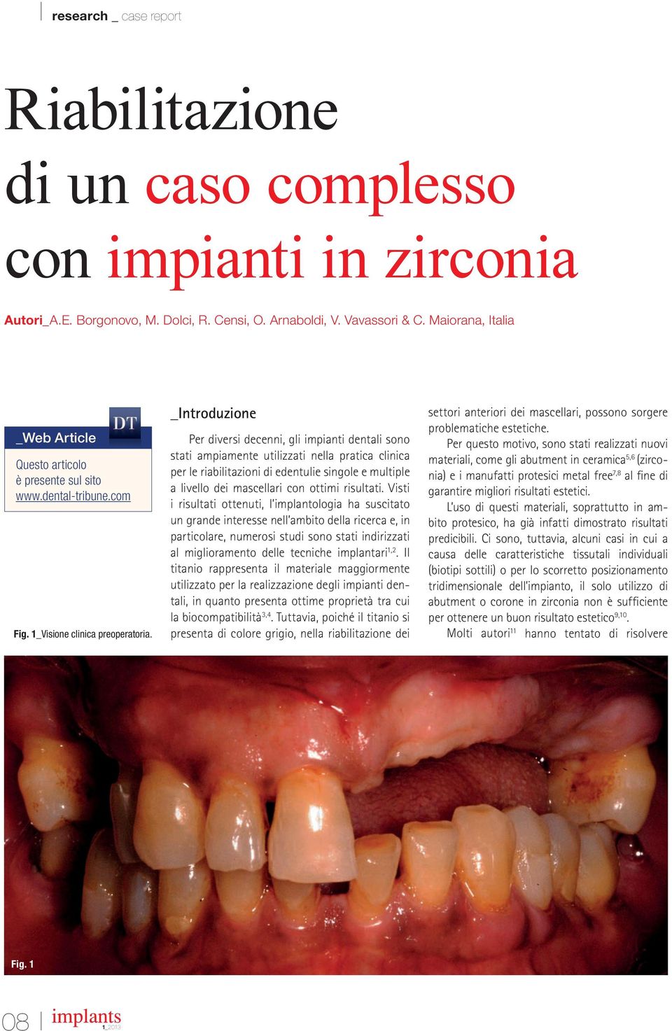 _Introduzione Per diversi decenni, gli impianti dentali sono stati ampiamente utilizzati nella pratica clinica per le riabilitazioni di edentulie singole e multiple a livello dei mascellari con