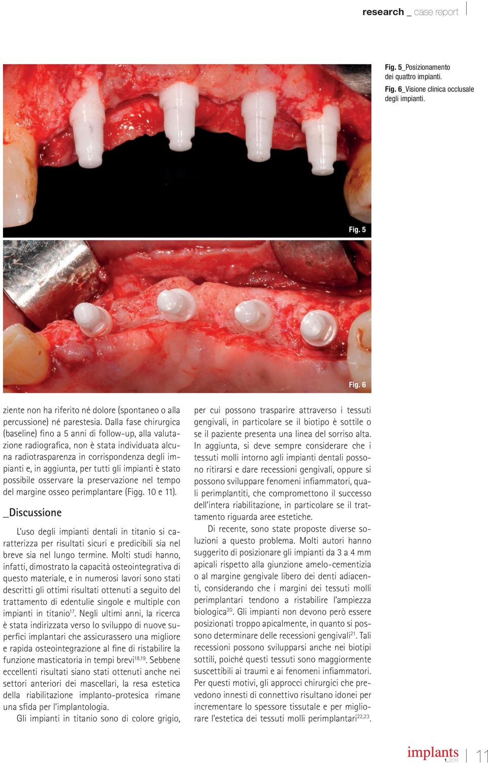 gli impianti è stato possibile osservare la preservazione nel tempo del margine osseo perimplantare (Figg. 10 e 11).