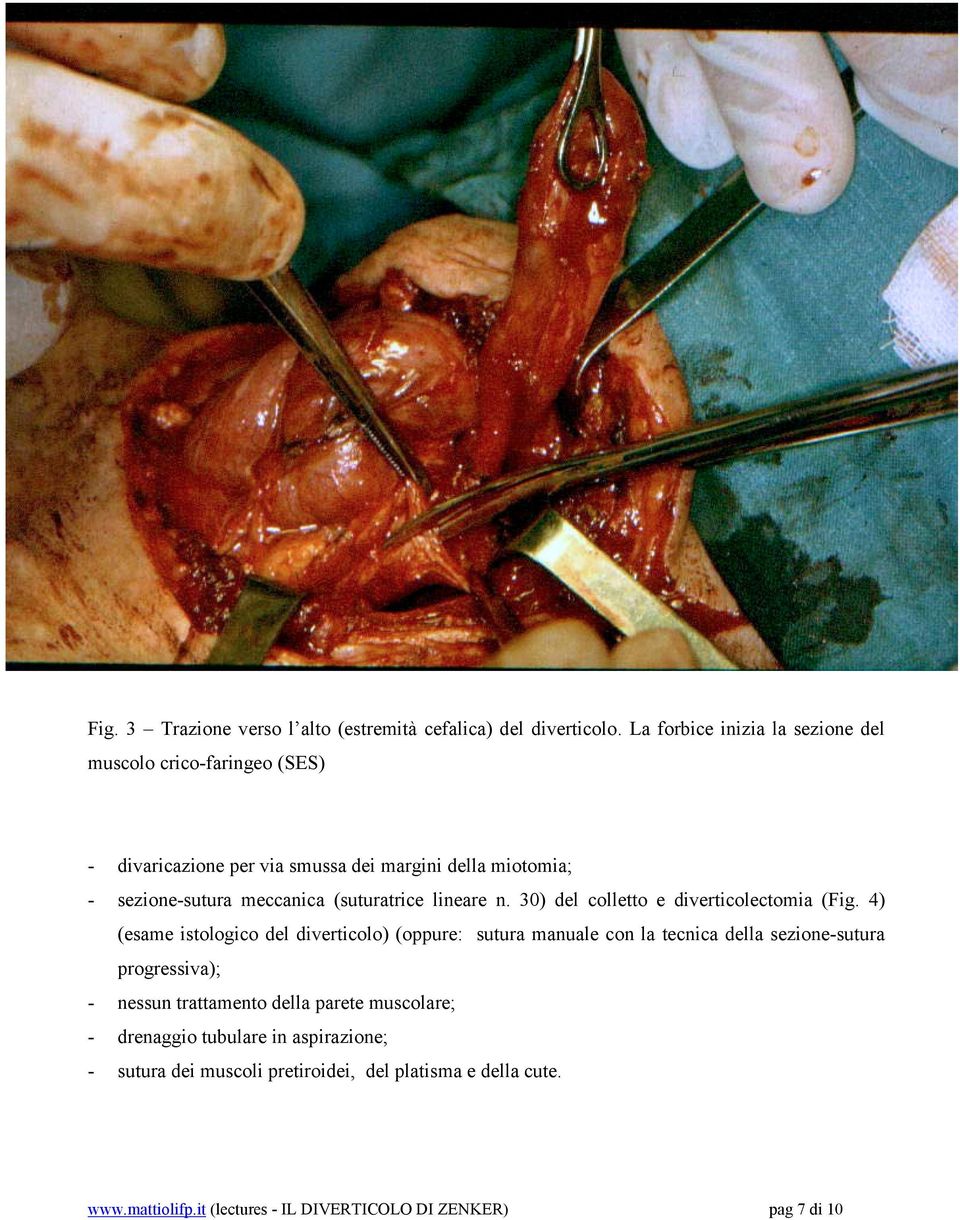 (suturatrice lineare n. 30) del colletto e diverticolectomia (Fig.