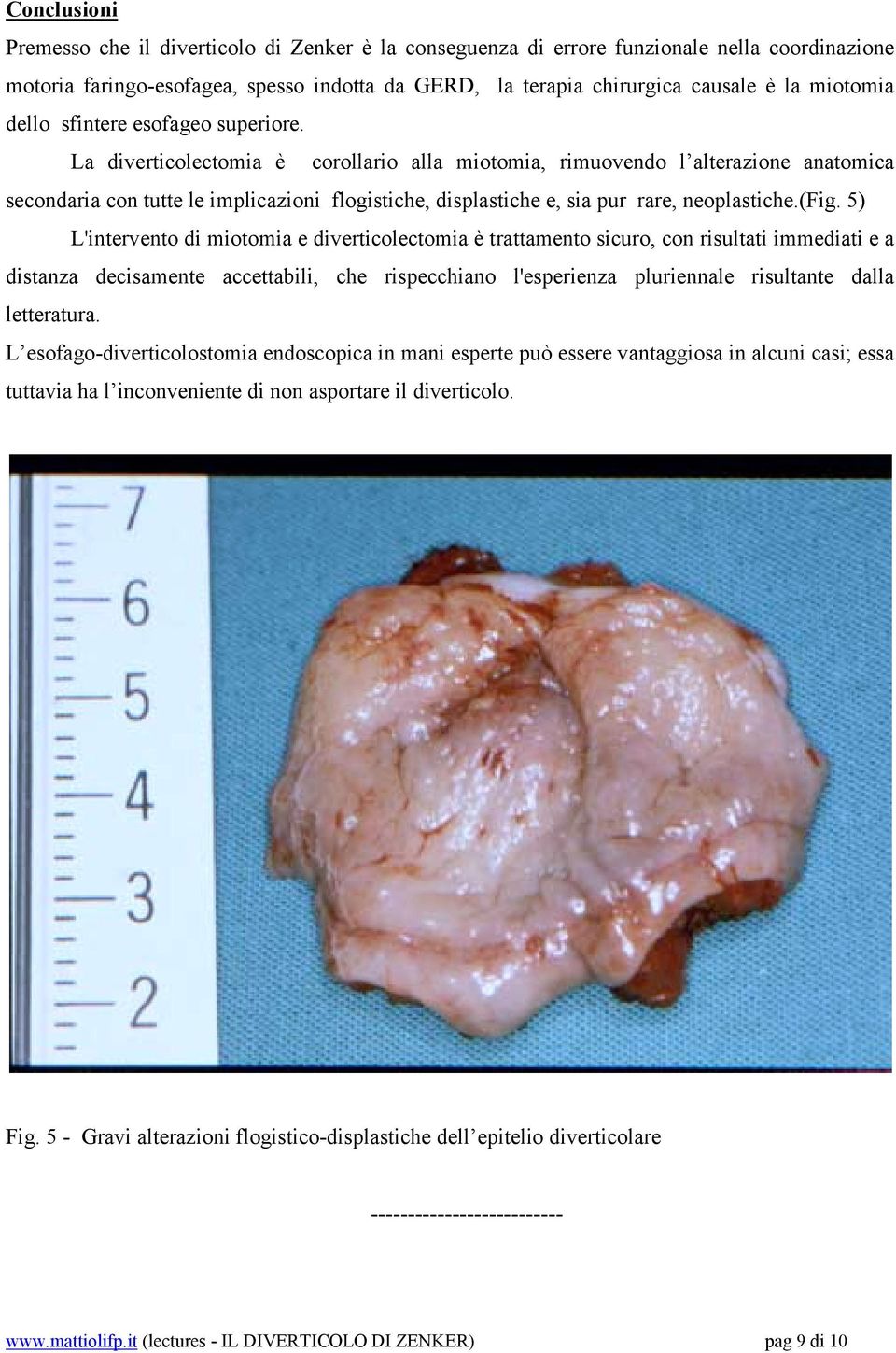 La diverticolectomia è corollario alla miotomia, rimuovendo l alterazione anatomica secondaria con tutte le implicazioni flogistiche, displastiche e, sia pur rare, neoplastiche.(fig.