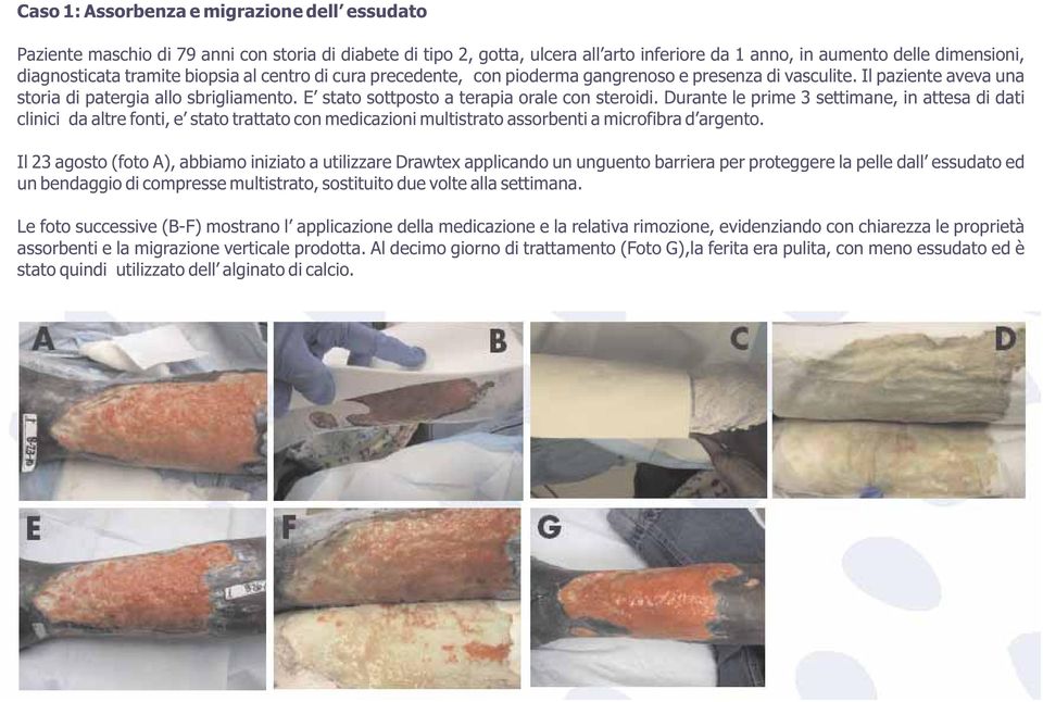 E stato sottposto a terapia orale con steroidi. Durante le prime 3 settimane, in attesa di dati clinici da altre fonti, e stato trattato con medicazioni multistrato assorbenti a microfibra d argento.