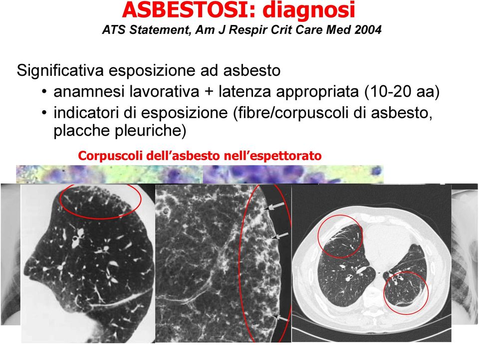dell asbesto strutturali nell espettorato Rx torace (o (o HRTC) istologia Assenza di di altre malattie Evidenza di di danno funzionale (non