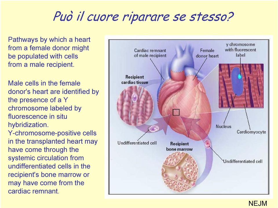 Male cells in the female donor's heart are identified by the presence of a Y chromosome labeled by fluorescence in
