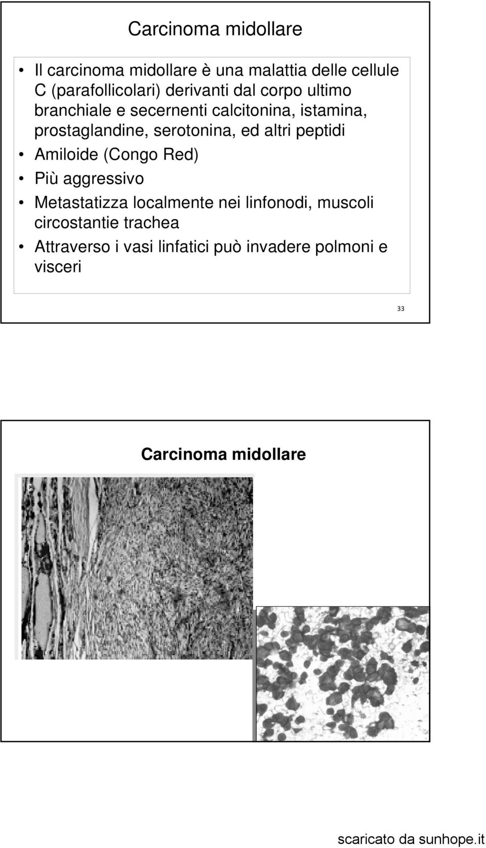 serotonina, ed altri peptidi Amiloide (Congo Red) Più aggressivo Metastatizza localmente nei