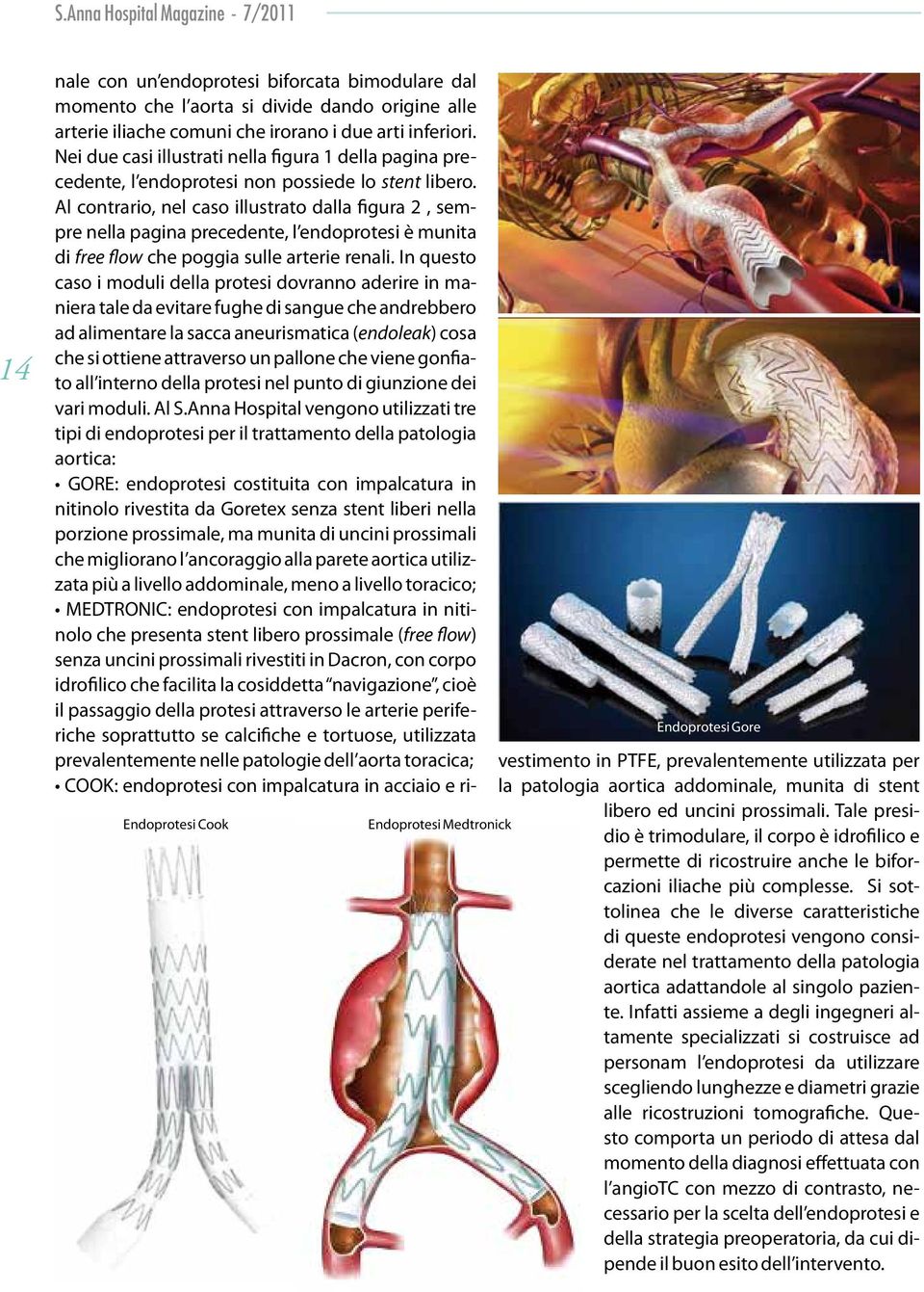 Al contrario, nel caso illustrato dalla figura 2, sempre nella pagina precedente, l endoprotesi è munita di free flow che poggia sulle arterie renali.