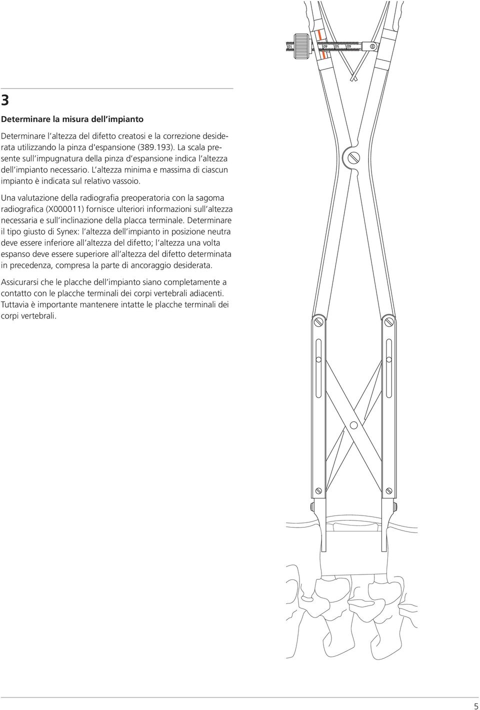 Una valutazione della radiografia preoperatoria con la sagoma radiografica (X000011) fornisce ulteriori informazioni sull altezza necessaria e sull inclinazione della placca terminale.