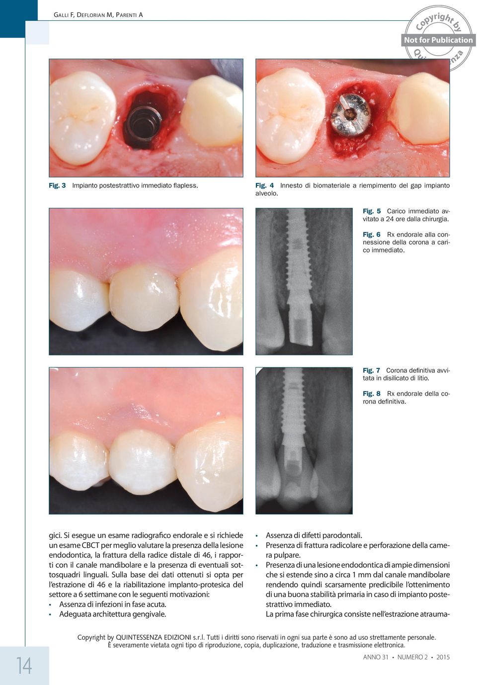 Si esegue un esame radiografico endorale e si richiede un esame CBCT per meglio valutare la presenza della lesione endodontica, la frattura della radice distale di 46, i rapporti con il canale