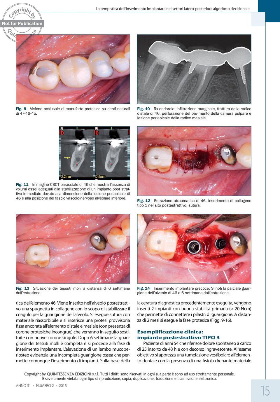 10 Rx endorale: infiltrazione marginale, frattura della radice distale di 46, perforazione del pavimento della camera pulpare e lesione periapicale della radice mesiale. Fig.