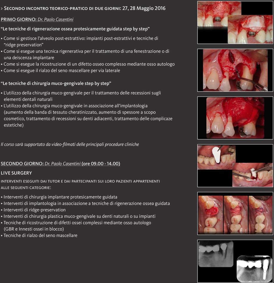 esegue una tecnica rigenerativa per il trattamento di una fenestrazione o di una deiscenza implantare Come si esegue la ricostruzione di un difetto osseo complesso mediante osso autologo Come si