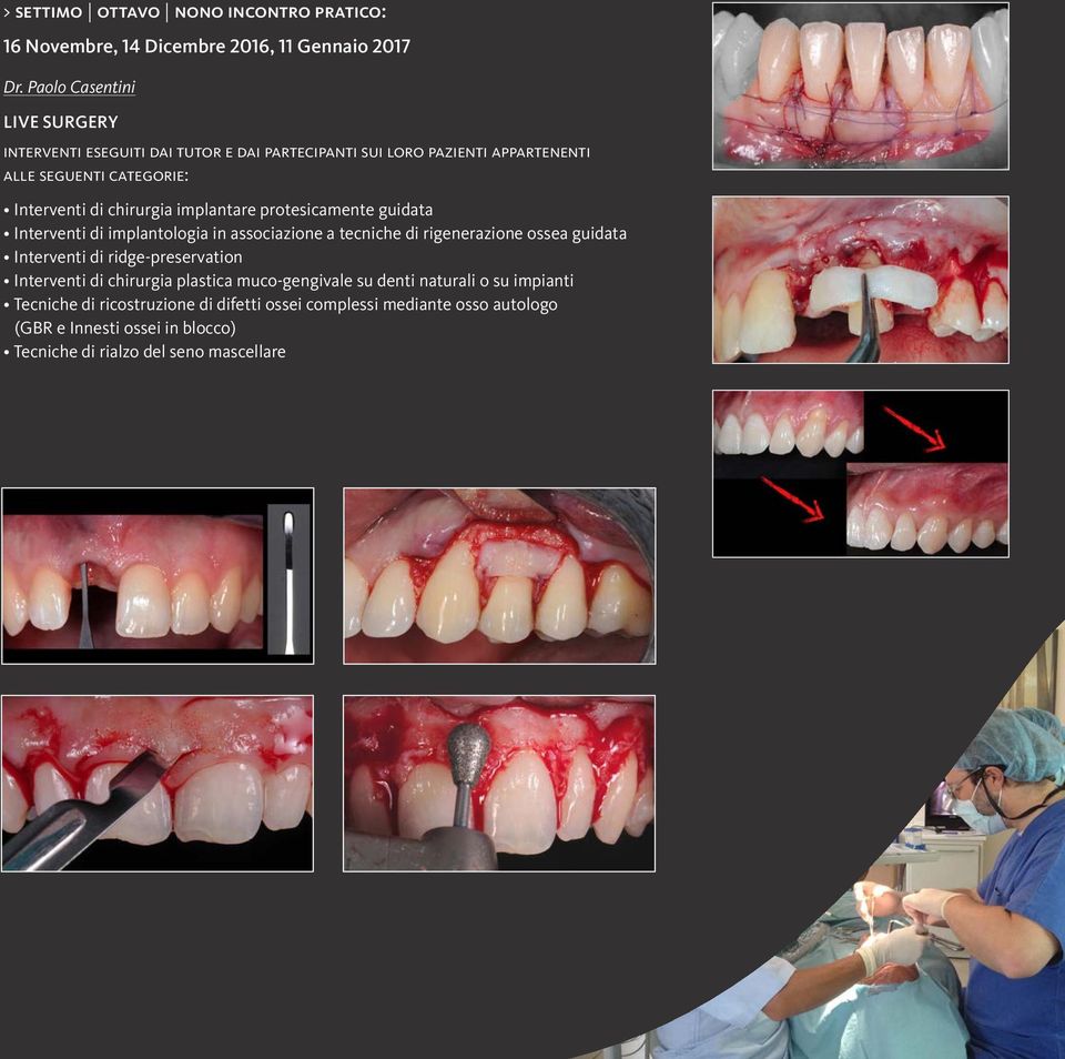 chirurgia implantare protesicamente guidata Interventi di implantologia in associazione a tecniche di rigenerazione ossea guidata Interventi di