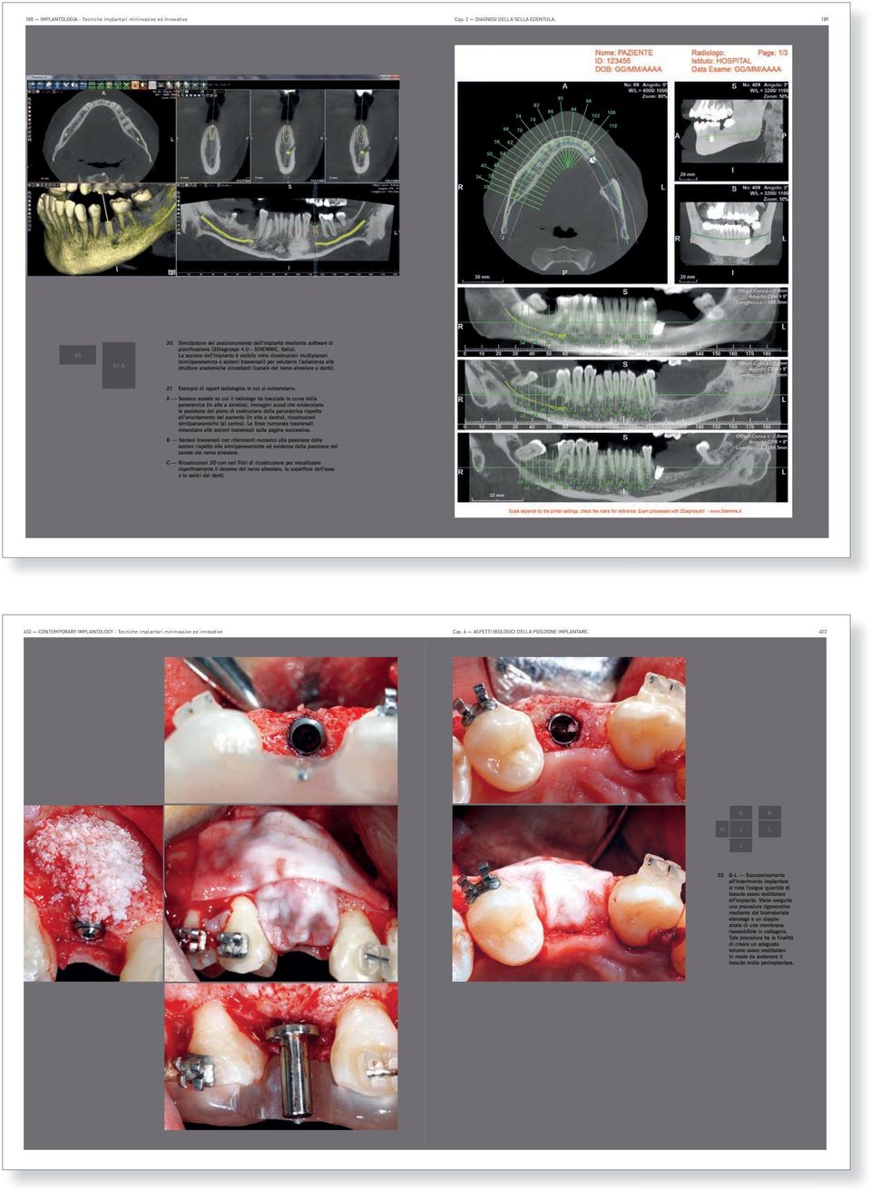 La sezione dell impianto è visibile nelle ricostruzioni multiplanari (similpanoramica e sezioni trasversali) per valutarne l adiacenza alle strutture anatomiche circostanti (canale del nervo