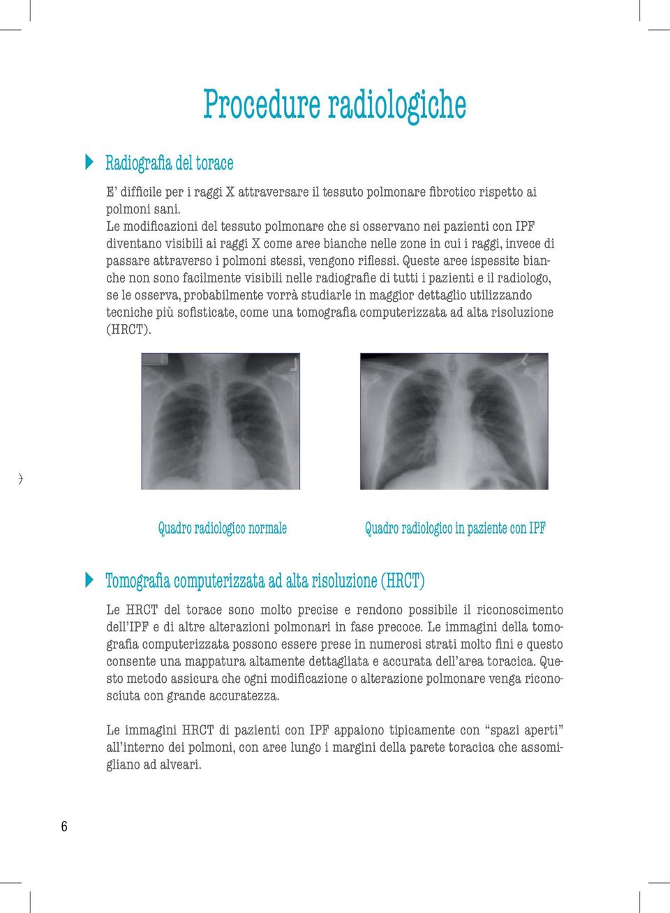 The Le modificazioni changes in lung del tissue tessuto that are polmonare seen in IPF patients che si osservano become visible nei on pazienti X-ray images con IPF as white areas diventano in the