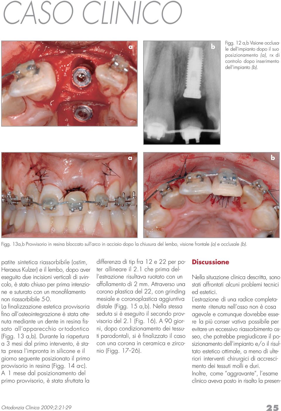 ptite sintetic rissoriile (ostim, Hereus Kulzer) e il lemo, dopo ver eseguito due incisioni verticli di svincolo, è stto chiuso per prim intenzione e suturto con un monofilmento non rissoriile 5-0.