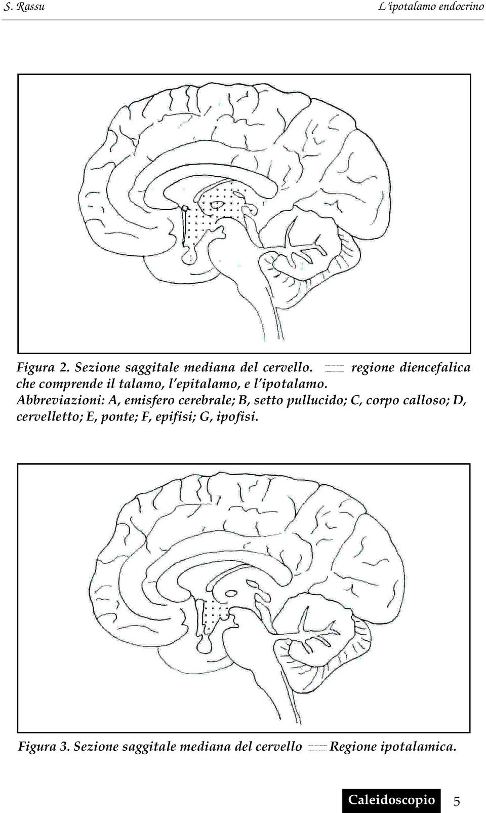 Abbreviazioni: A, emisfero cerebrale; B, setto pullucido; C, corpo calloso; D,