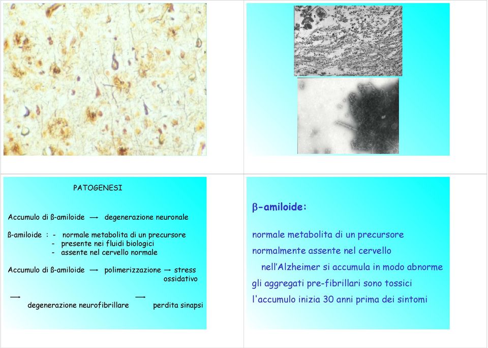 degenerazione neurofibrillare perdita sinapsi β-amiloide: normale metabolita di un precursore normalmente assente nel