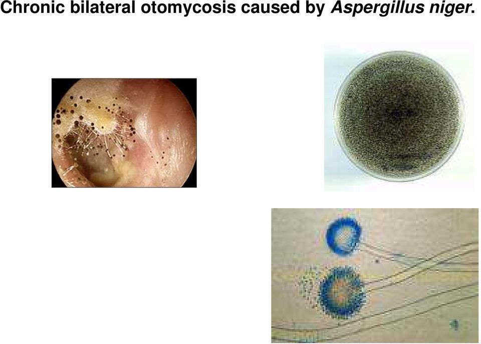 otomycosis