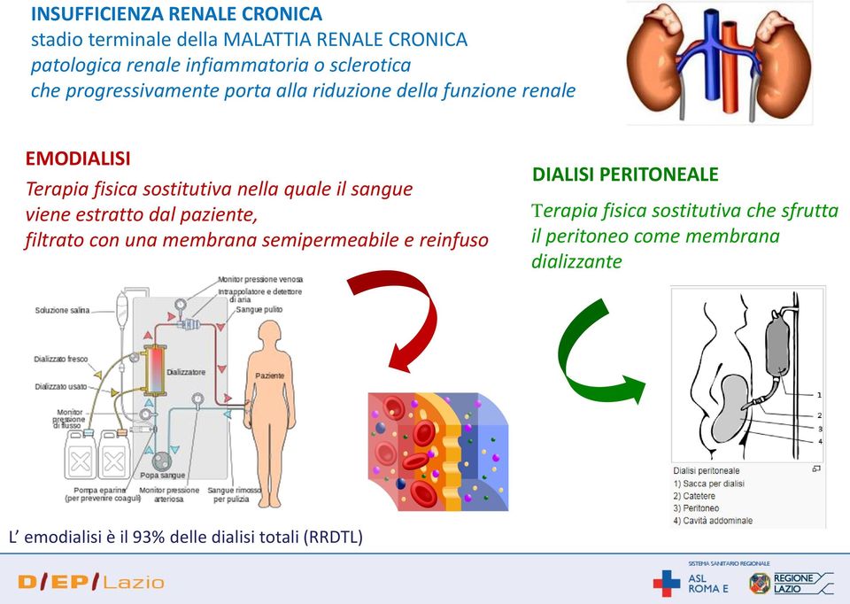 quale il sangue viene estratto dal paziente, filtrato con una membrana semipermeabile e reinfuso DIALISI PERITONEALE