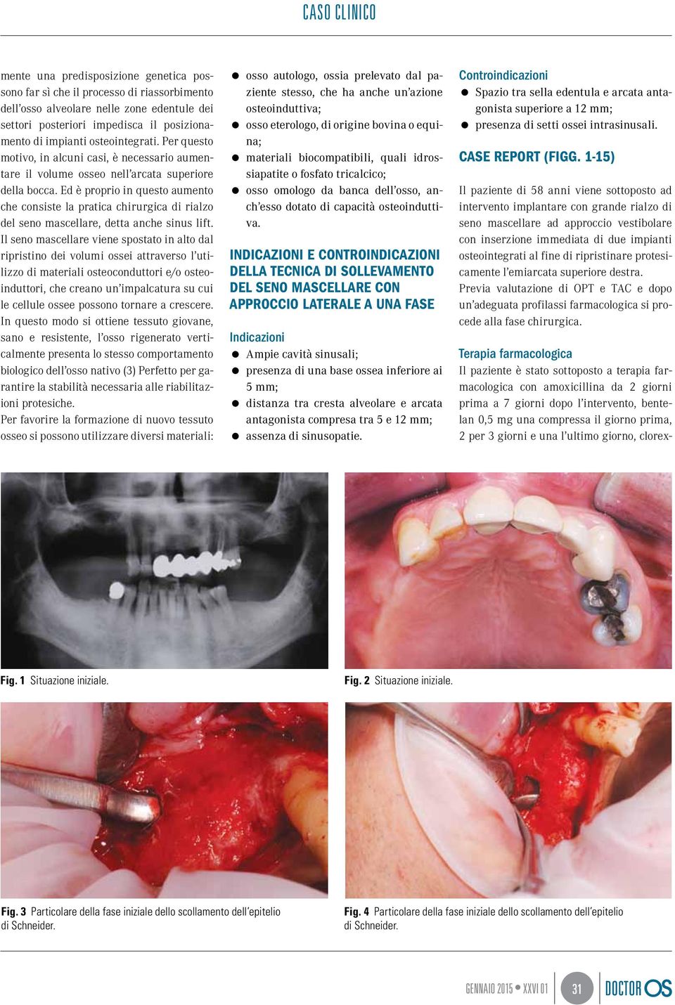 posizionamento di impianti osteointegrati. Per questo motivo, in alcuni casi, è necessario aumentare il volume osseo nell arcata superiore della bocca.