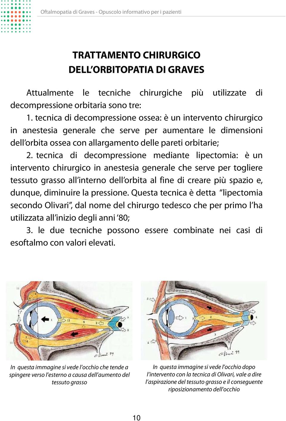 tecnica di decompressione mediante lipectomia: è un intervento chirurgico in anestesia generale che serve per togliere tessuto grasso all interno dell orbita al fine di creare più spazio e, dunque,