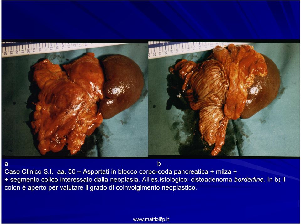 segmento colico interessato dalla neoplasia. All es.