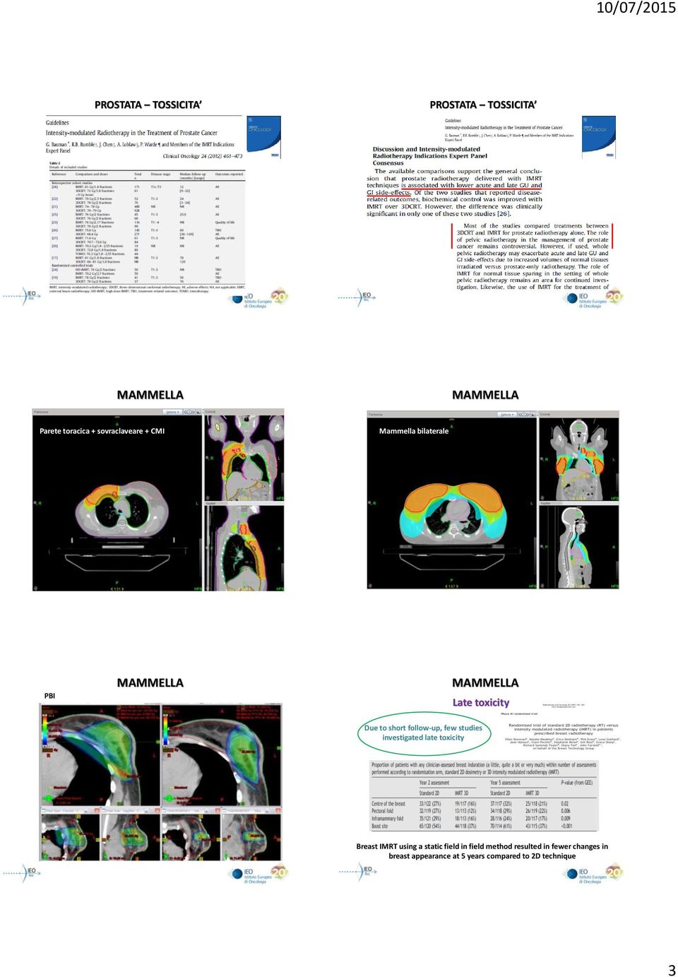 investigated late toxicity Breast using a static field in field method