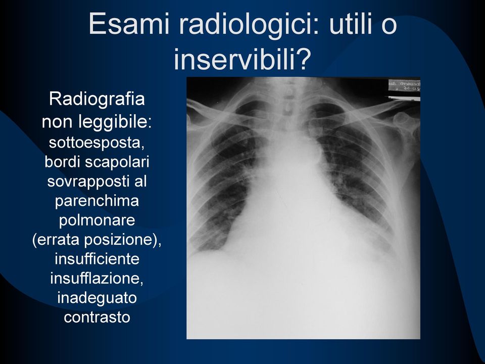 sovrapposti al parenchima polmonare (errata