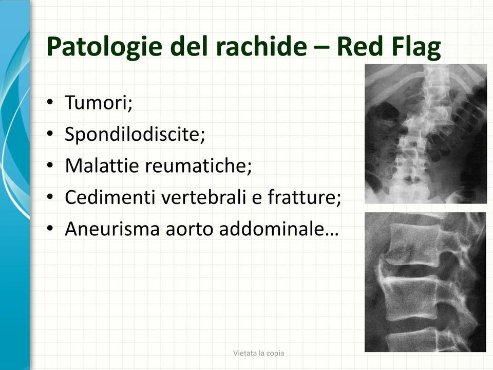 reumatiche; Cedimenti vertebrali