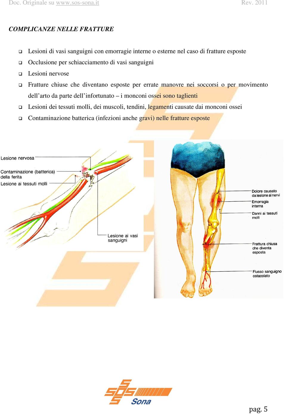 nei soccorsi o per movimento dell arto da parte dell infortunato i monconi ossei sono taglienti Lesioni dei tessuti molli,