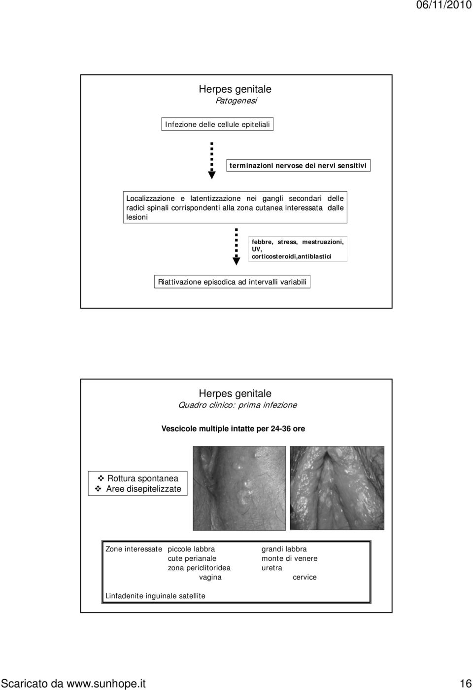 intervalli variabili Herpes genitale Quadro clinico: prima infezione Vescicole multiple intatte per 24-36 ore Rottura spontanea Aree disepitelizzate Zone