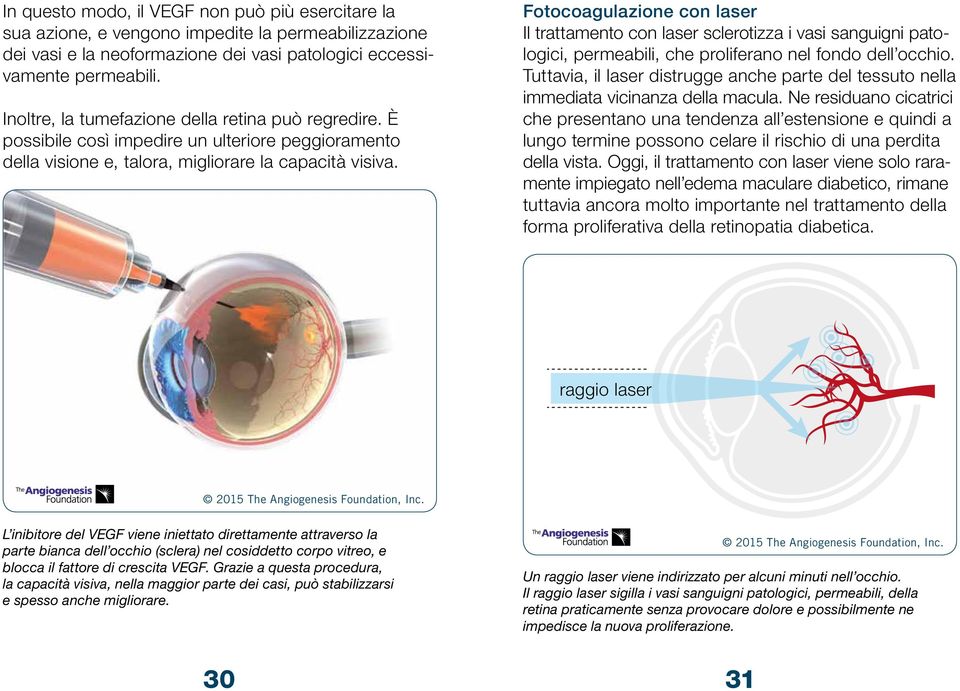 Fotocoagulazione con laser Il trattamento con laser sclerotizza i vasi sanguigni patologici, permeabili, che proliferano nel fondo dell occhio.