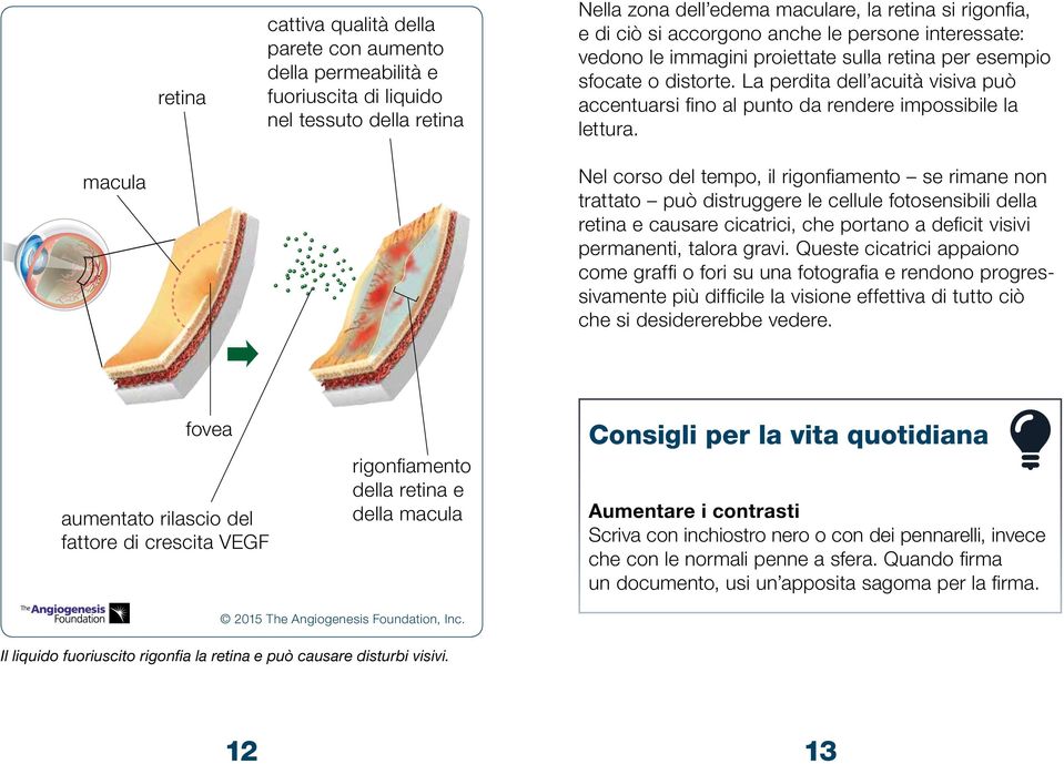 La perdita dell acuità visiva può accentuarsi fi no al punto da rendere impossibile la lettura.